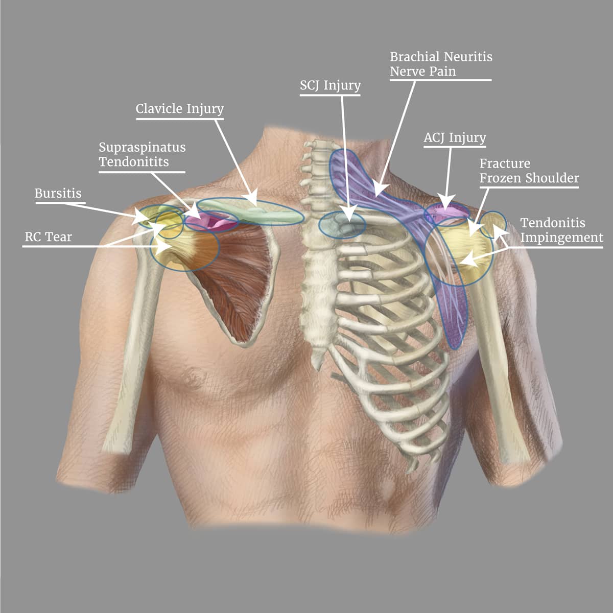 Shoulder Symptom Chart