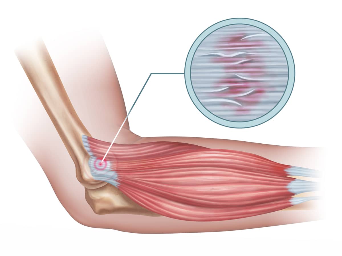 Tendonitis Treatment