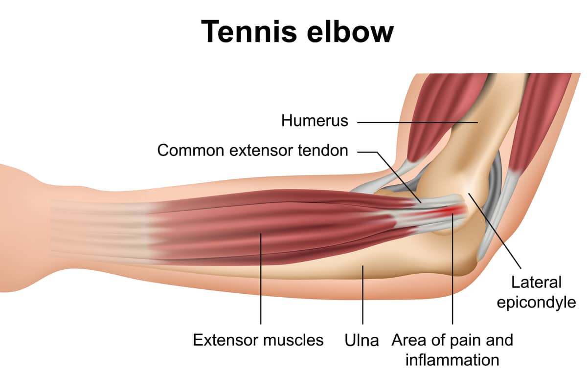 Tennis Elbow Diagram