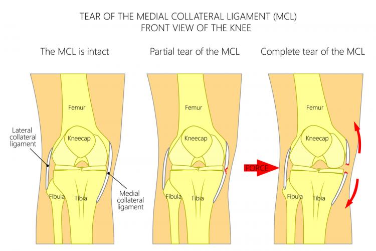 The MCL Injury The Stone Clinic