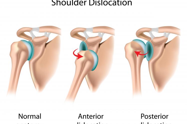 The Too Flexible Athlete The Stone Clinic