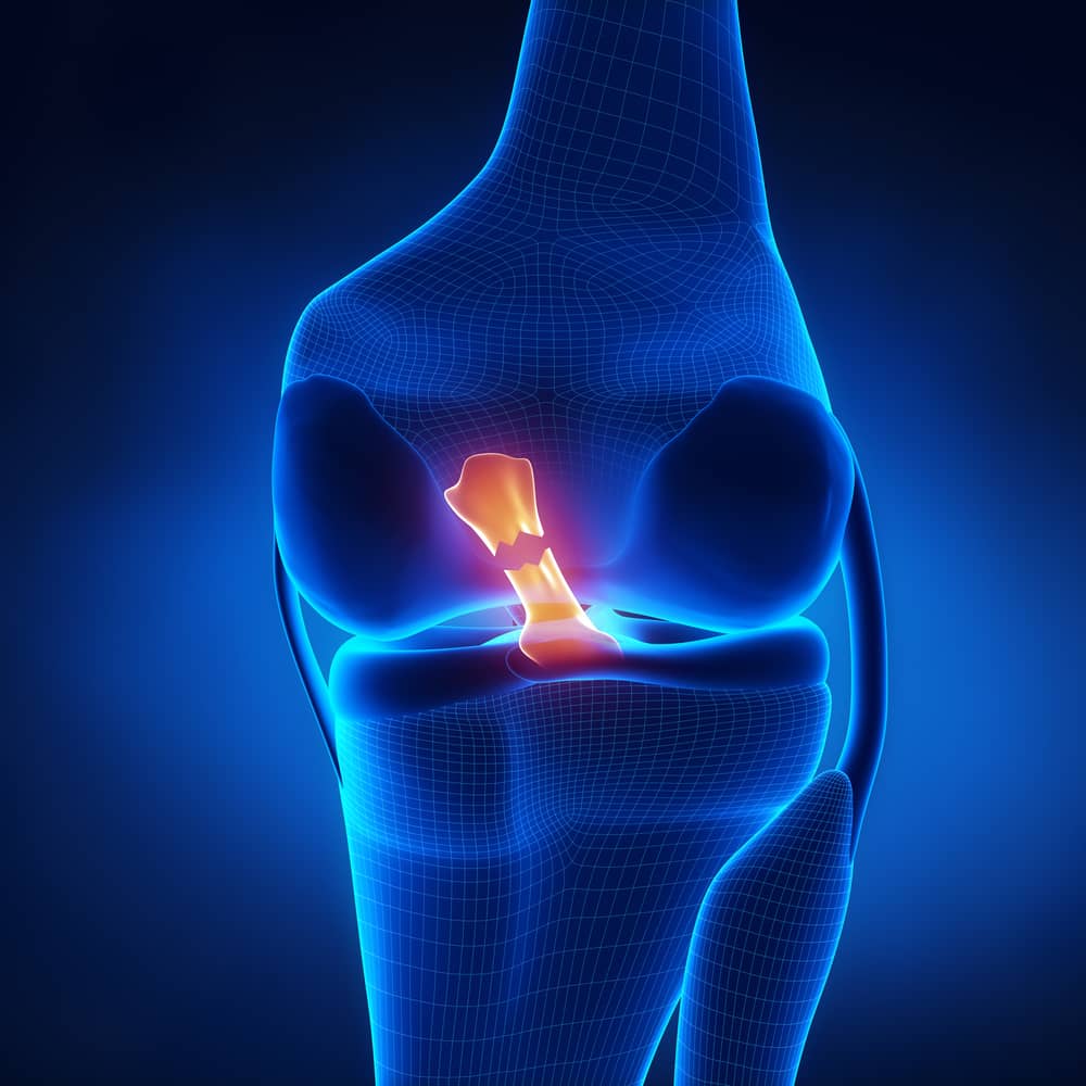 ACL Anterior Cruciate Ligament Reconstruction and Repair