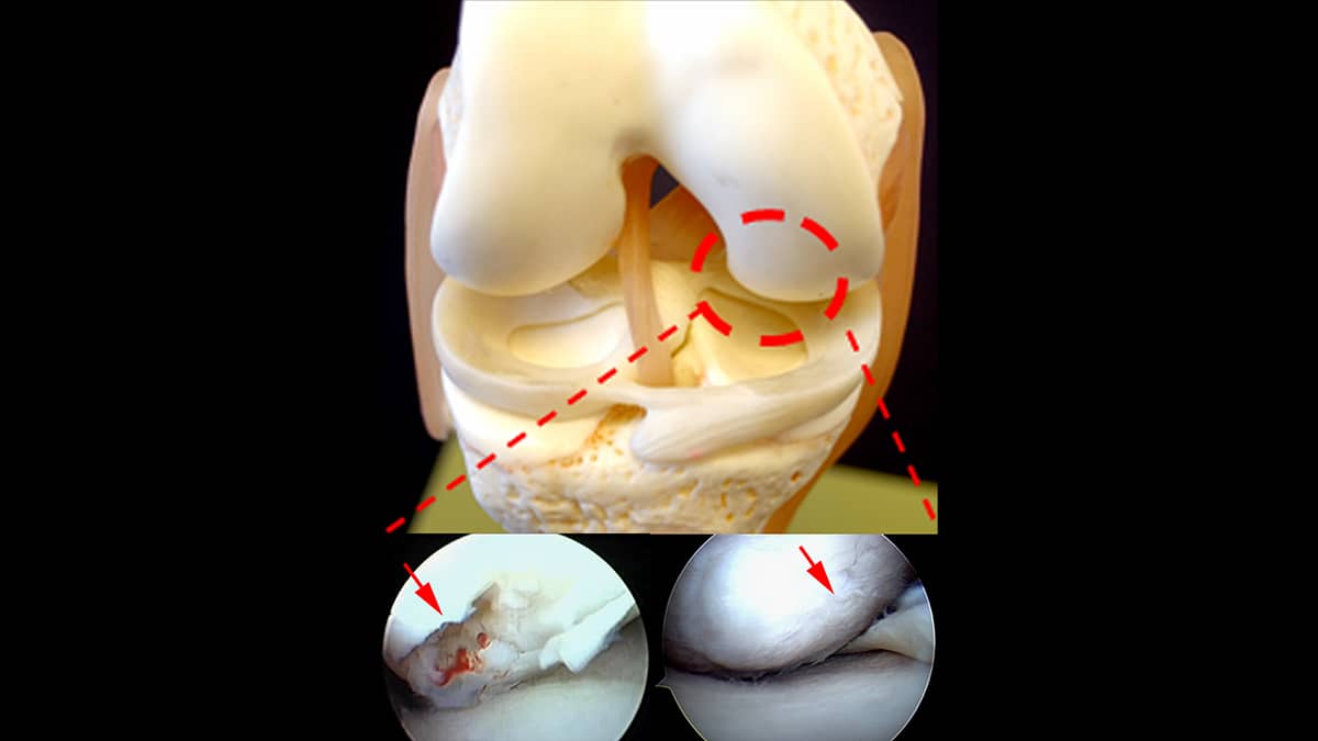 Revised Cartilage Surgery Repair