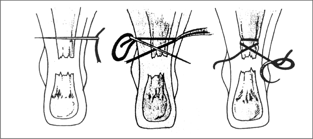 achilles percutaneous