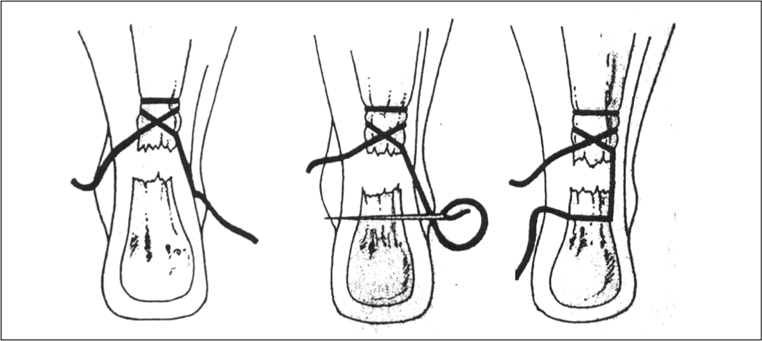 achilles percutaneous1