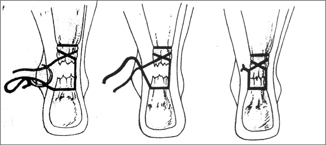achilles percutaneous2