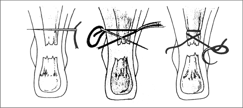 Achilles Percutaneous Repair