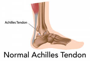 achilles pain without injury