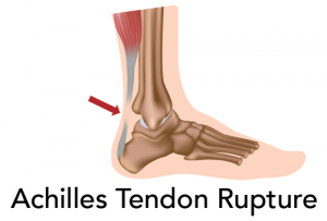 Achilles Tendon Repair Rehab Protocol 