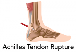 pain outside of achilles tendon