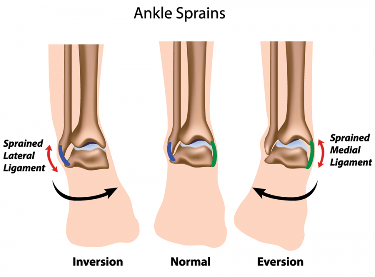 Ankle Sprain | Symptoms, Treatment, & Recovery Time