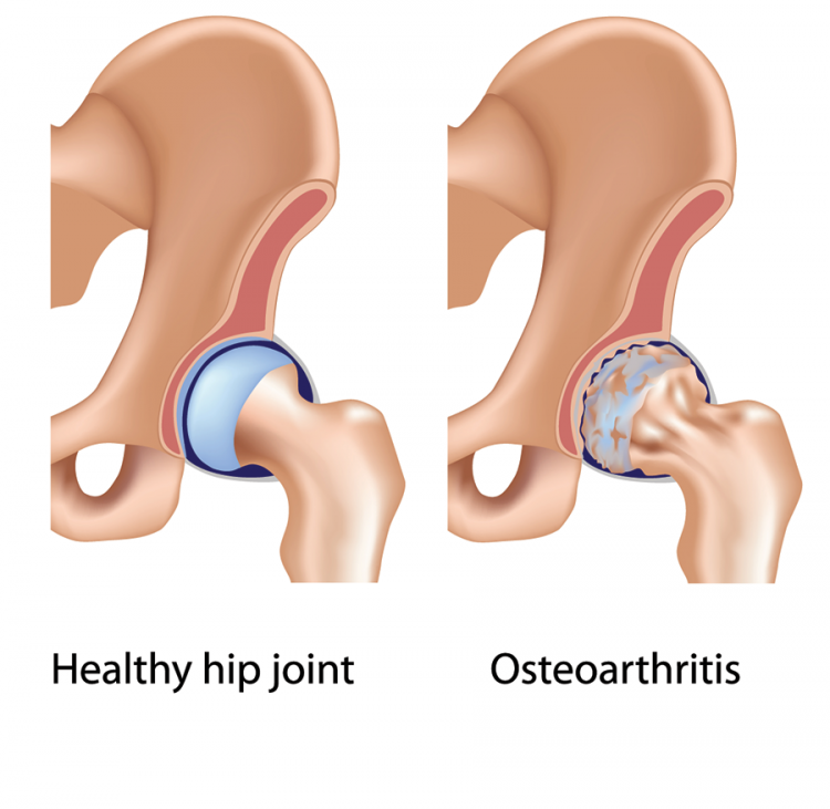 hip injury