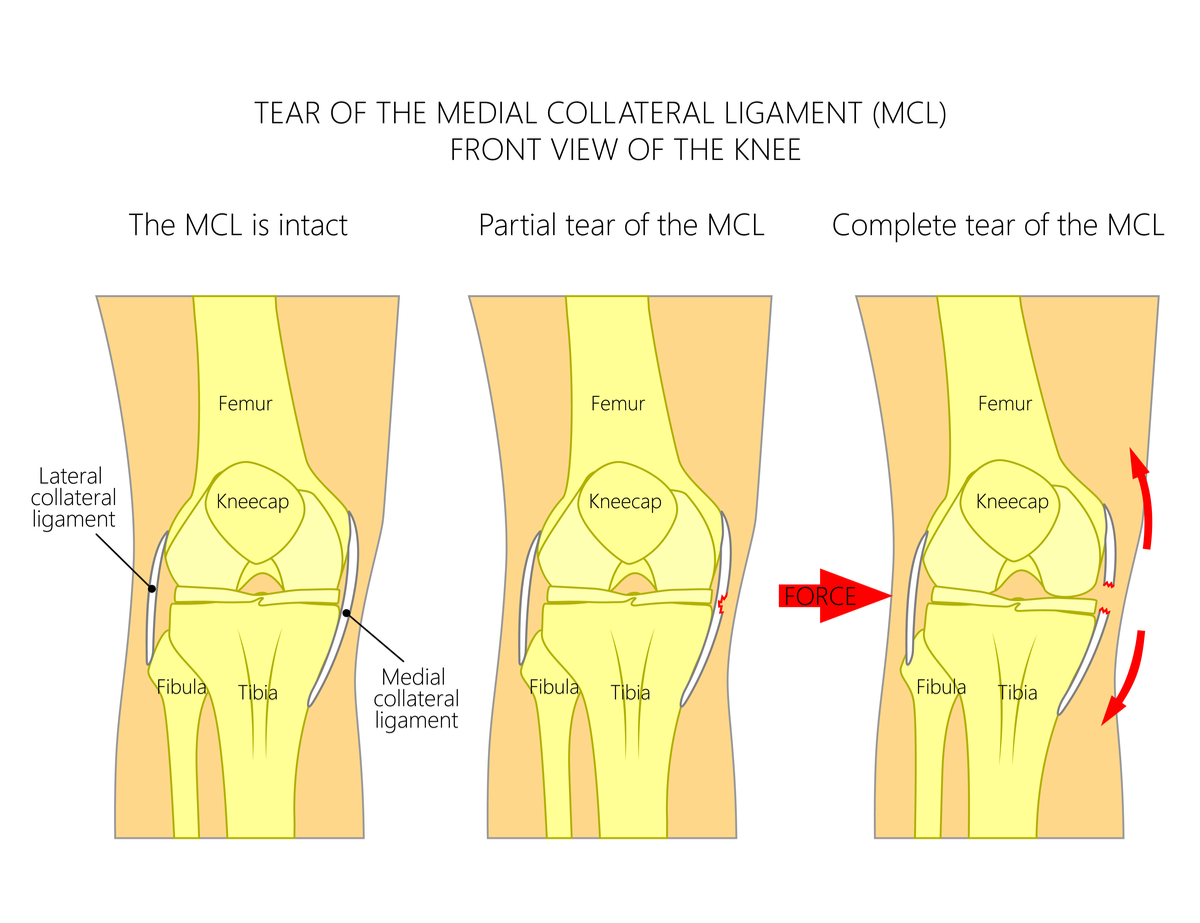 What does an MCL tear feel like?