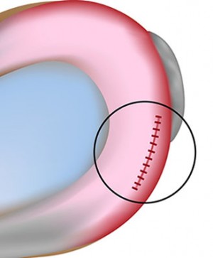 meniscus repair