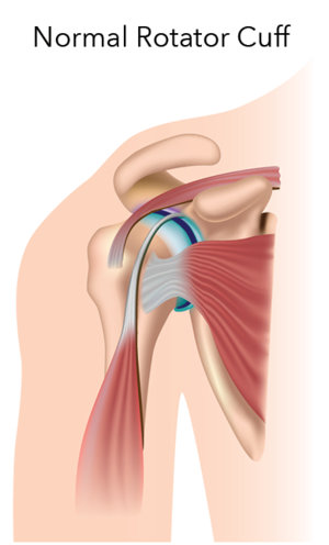 torn rotator cuff tear