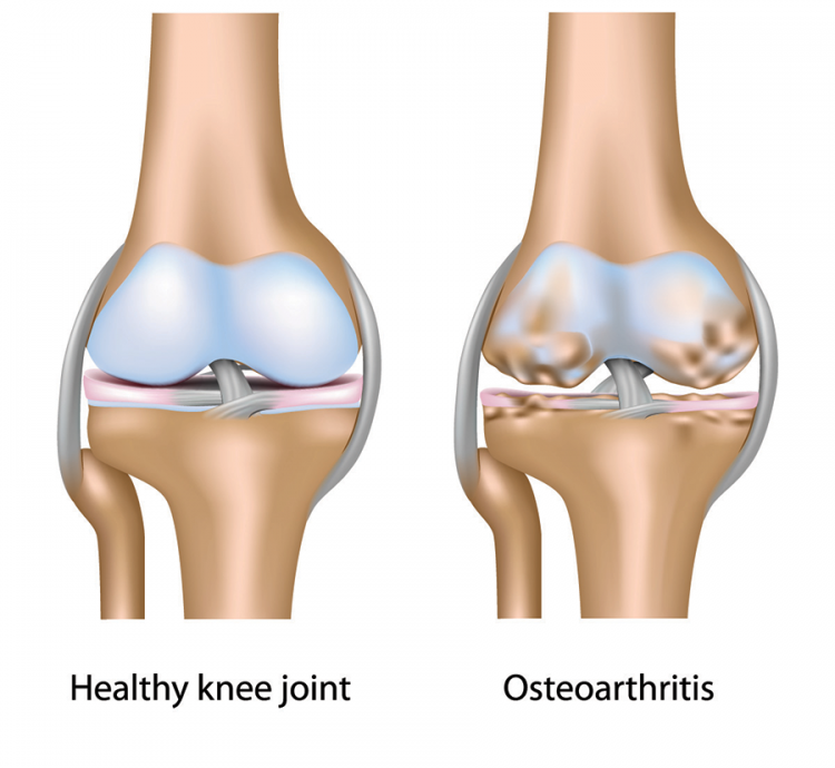 Arthritis, Definition, Causes, & Treatment