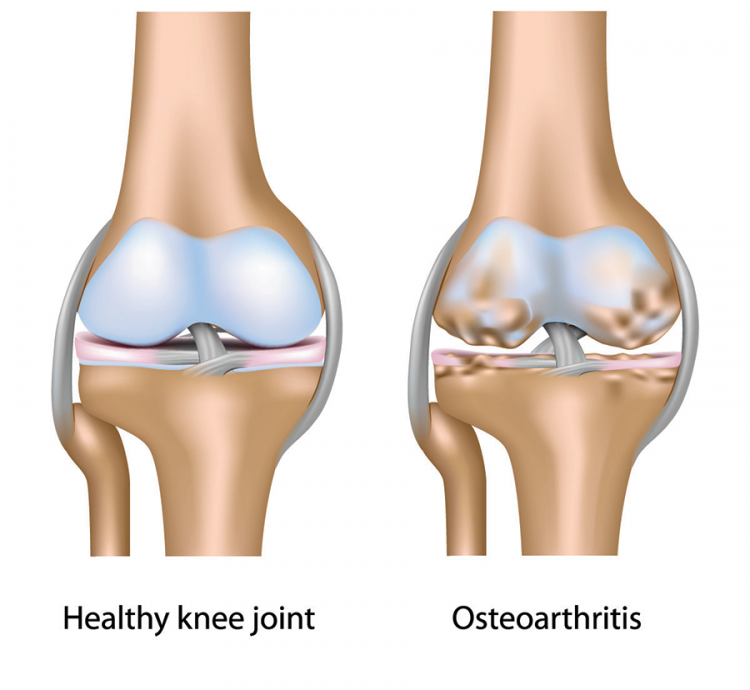 Osteoarthritis klinika