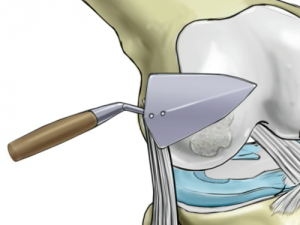 articular cartilage paste graft