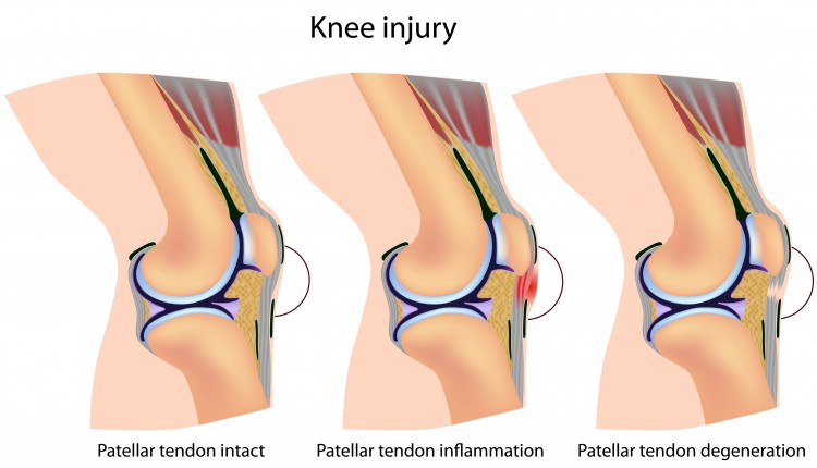 Patella Tendon Injury  Symptoms, Treatment, & Recovery Time