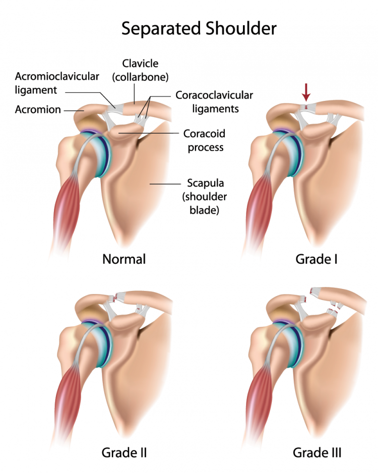 separated shoulder