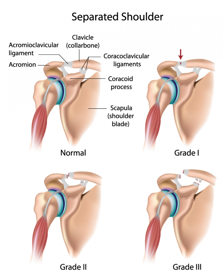 Shoulder Separation  AC Joint Injury Symptoms & Repair