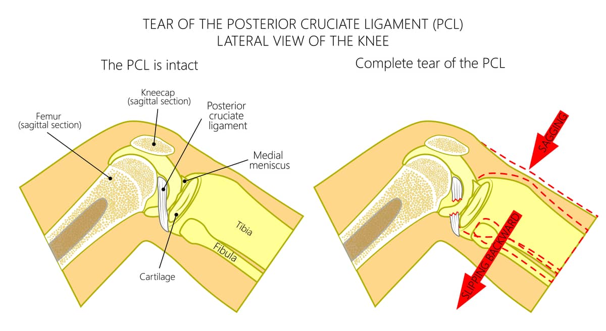 Instability after PCL Injury