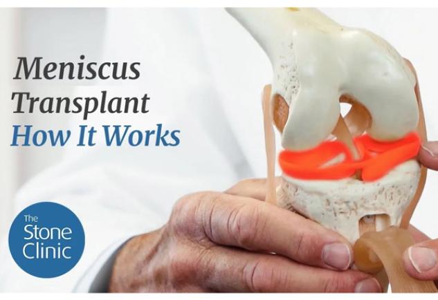 Meniscus Transplant How it Works