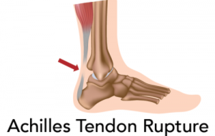 Achilles tendon rupture 