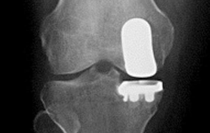 Knee replacement: Partial can be just as good as total