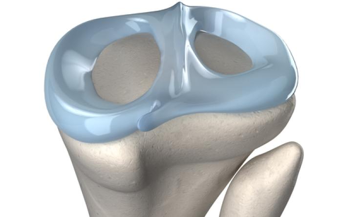 Fix a meniscus to avoid arthritis