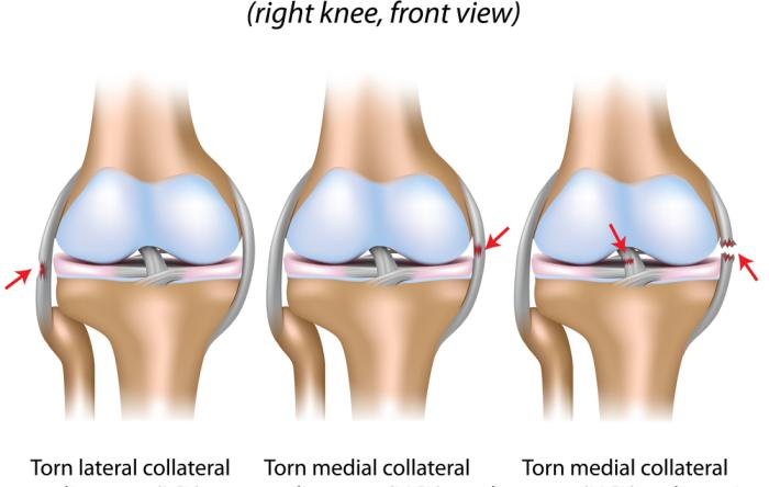 Knee ligament injuries, ACL-LCL-PCL-MCL-PCL-ALL