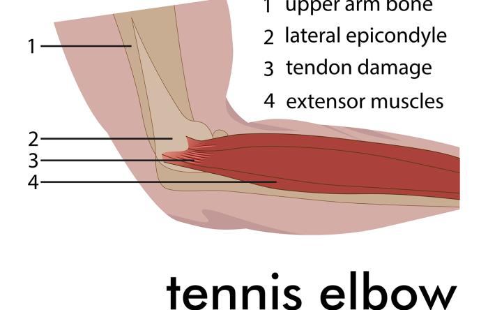 Epicondylitis, aka Tennis Elbow: Pain in the Wings