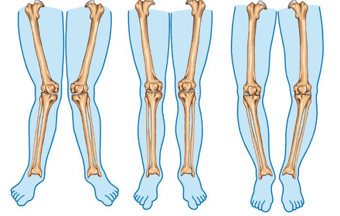 Tissue-replacement-better-choice-for-leg-curvature-caused-by-arthritis 