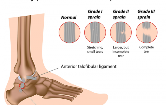 Twisted your ankle? Give it time to heal