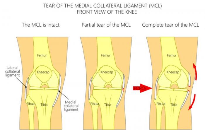 The MCL Injury The Stone Clinic