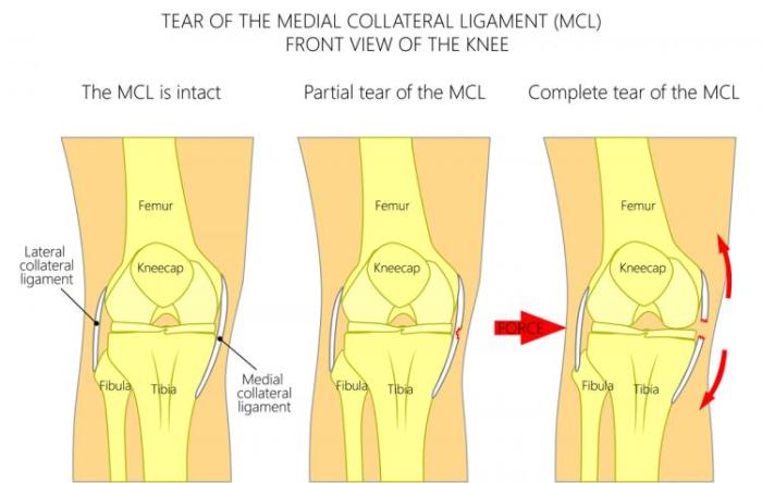 The MCL Injury The Stone Clinic