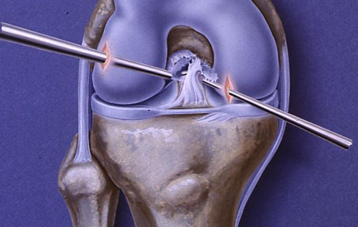 ACL Repair Surgery & Rehab