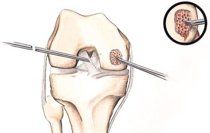 Microfracture Surgery Diagram - Failed Microfracture