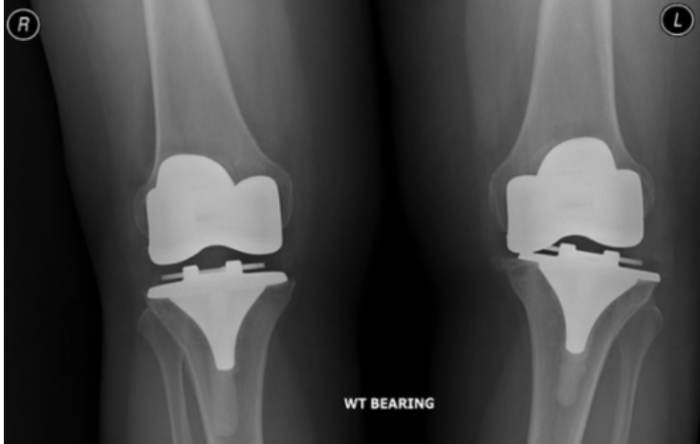 Failed Total Knee Replacement