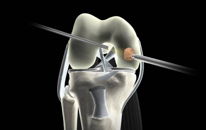 Articular Cartilage Surgery Repair Diagram
