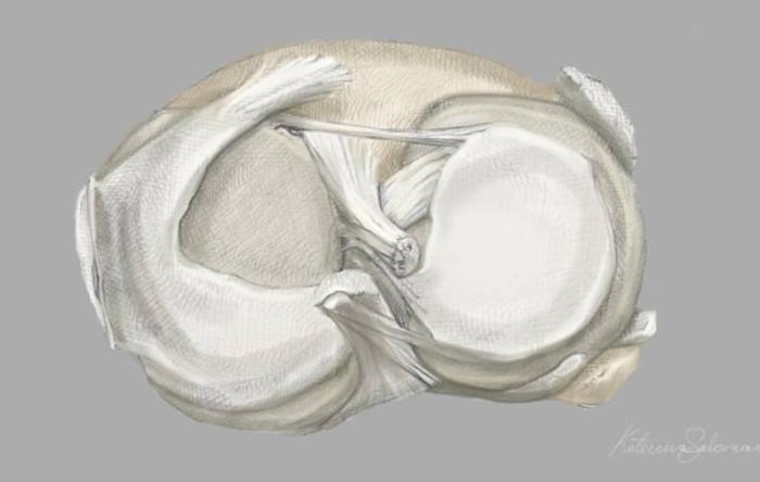 Anatomical Sketch of Discoid Meniscus collagen abnormality