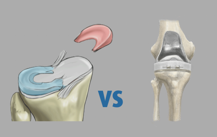 Knee Replacement Options in 2021