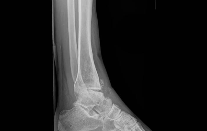 Why to Avoid Ankle Fusion