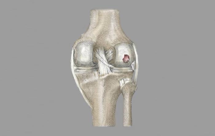 OCD Lesions Osteochondritis dissecans Knee Cartilage