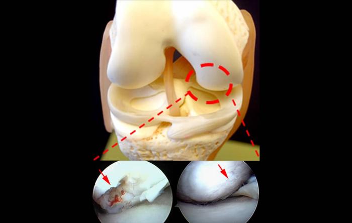 Knee Cartilage Revision Surgery