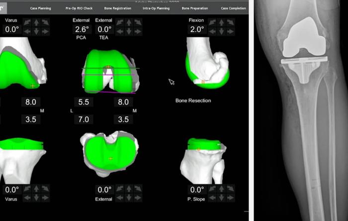 A) Mako robot for total knee arthroplasty. (B) Mako's computer