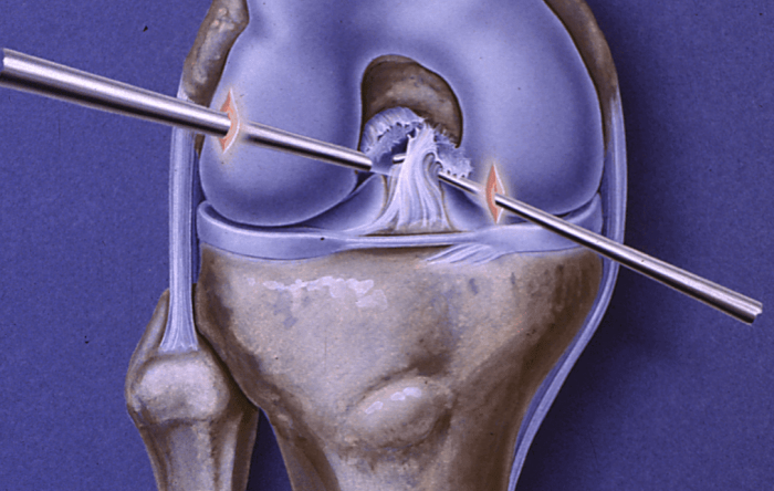 ACL Reconstruction vs Repair 