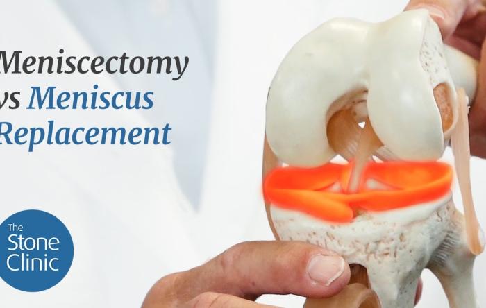 Meniscectomy vs Meniscus Replacement