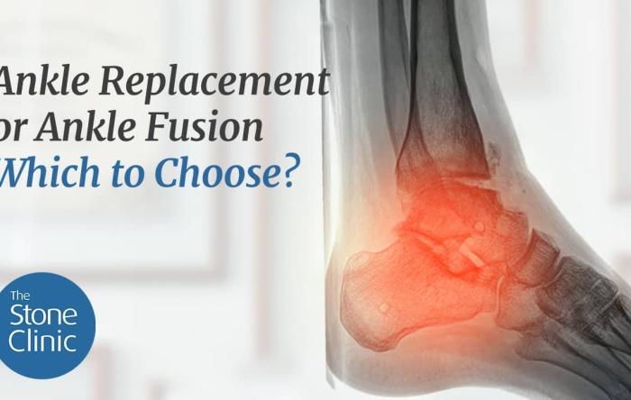 Ankle Replacement or Ankle Fusion