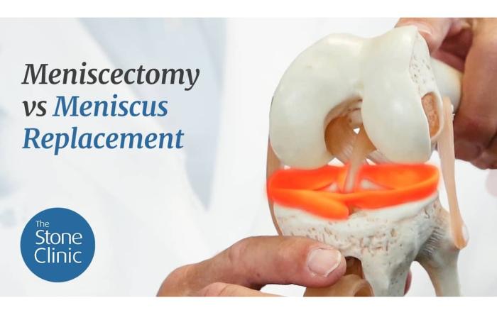 Meniscectomy vs Meniscus Replacement 